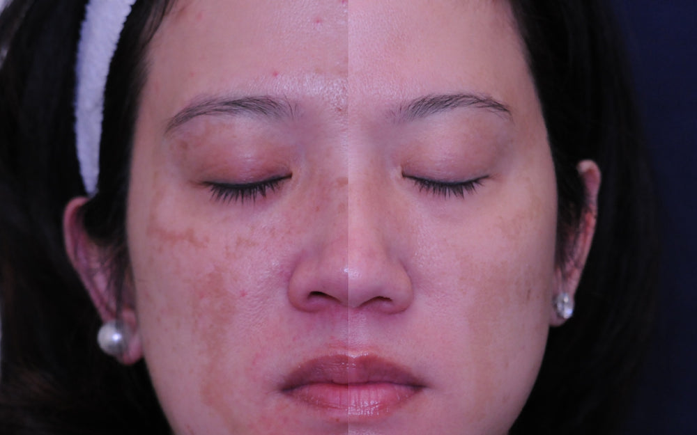 Webinar: Melasma - Diagnoses and Treatment
