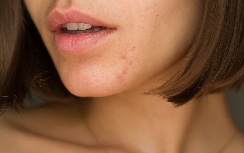 Skin Routine for Acne Prone Skin